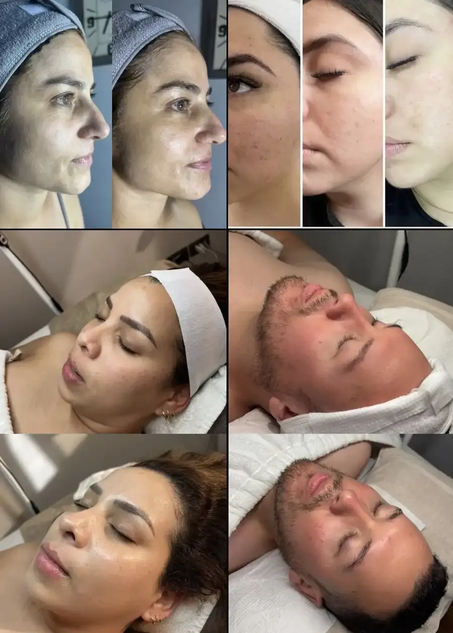 Resultados antes y después de tratamientos faciales en Glowment Studio
